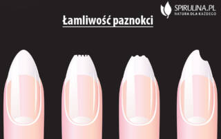 Łamliwość paznokci