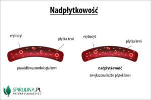 Nadpłytkowość