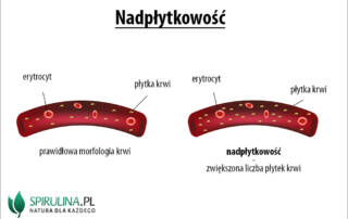 Nadpłytkowość