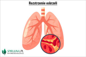 Rozstrzenie oskrzeli