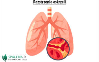 Rozstrzenie oskrzeli