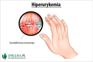 Hiperurykemia 