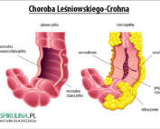 Choroba Leśniowskiego-Crohna