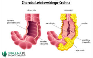 Choroba Leśniowskiego-Crohna