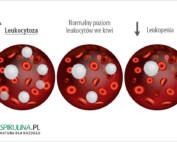 Leukocytoza