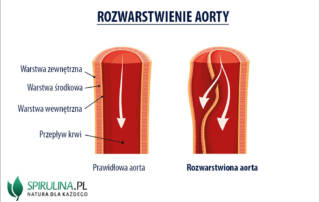 Rozwarstwienie aorty