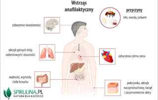 Wstrząs anafilaktyczny