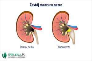 Zastój moczu w nerce