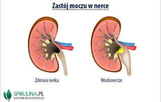 Zastój moczu w nerce