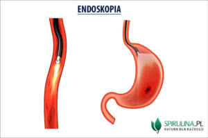 Endoskopia