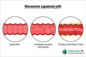 Nieswoiste zapalenie jelit