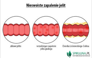 Nieswoiste zapalenie jelit