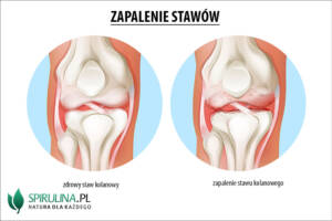 Zapalenie stawów