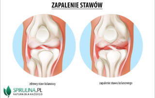 Zapalenie stawów