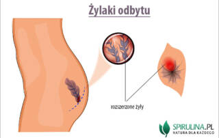 Żylaki odbytu