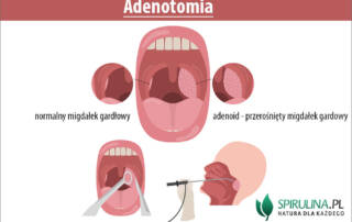 Adenotomia