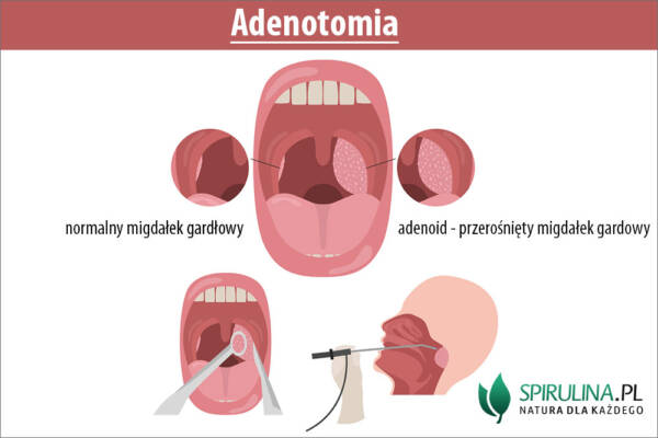 Adenotomia - algi Spirulina i Chlorella