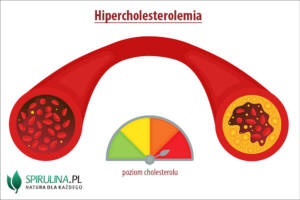 Hipercholesterolemia