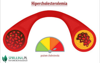 Hipercholesterolemia