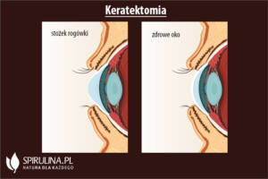 Keratektomia