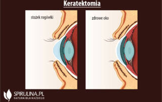 Keratektomia