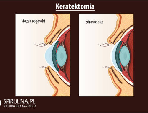 Keratektomia
