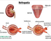 Nefropatia