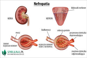 Nefropatia