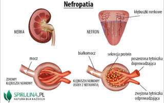 Nefropatia