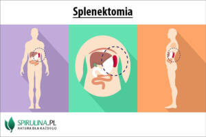 Splenektomia