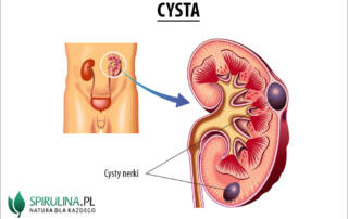 Cysta