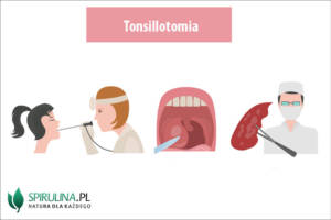 Tonsillotomia