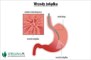 Wrzody żołądka