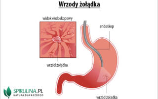 Wrzody żołądka