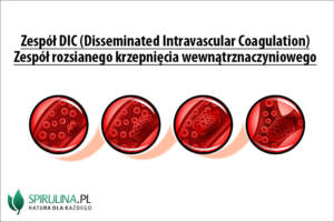 Zespół DIC
