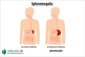 Splenomegalia