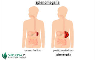 Splenomegalia