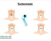 Tracheostomia