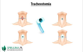 Tracheostomia