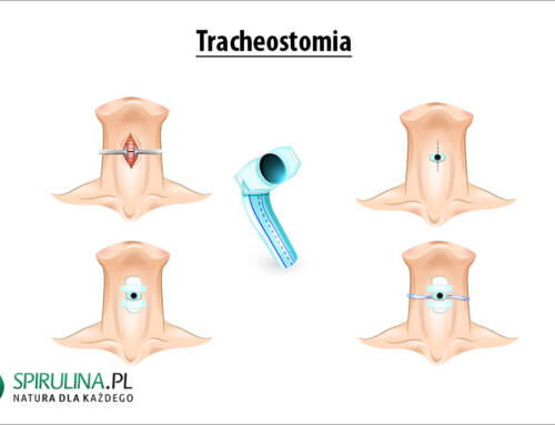 Tracheostomia