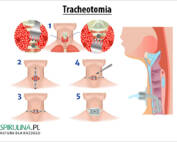 Tracheotomia