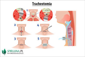 Tracheotomia