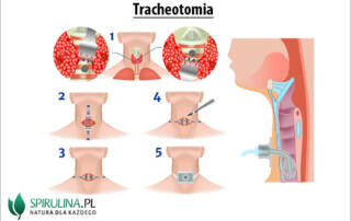 Tracheotomia