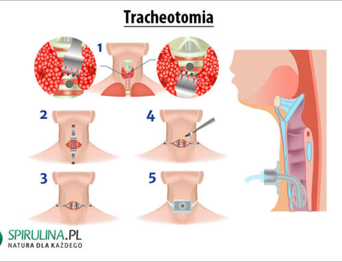 Tracheotomia