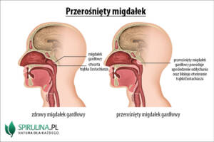 Przerośnięty migdałek