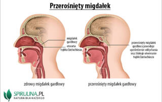 Przerośnięty migdałek