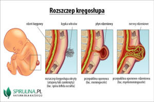 Rozszczep kręgosłupa