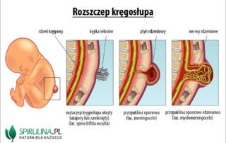 Rozszczep kręgosłupa