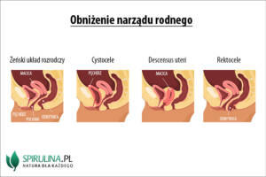 Obniżenie narządu rodnego