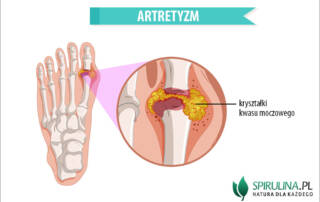Artretyzm